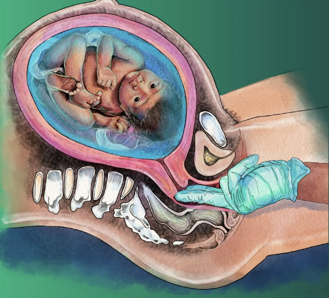 Illustrated graphic that shows organs, uterus and fetus, vaginal canal and cervix. Cervical exam is being performed